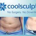 All you need to know about CoolSculpting